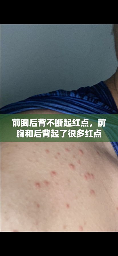 前胸后背不断起红点,前胸和后背起了很多红点不痛不痒
