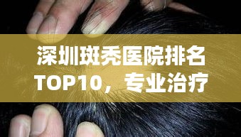 深圳斑秃医院排名TOP10,专业治疗一览